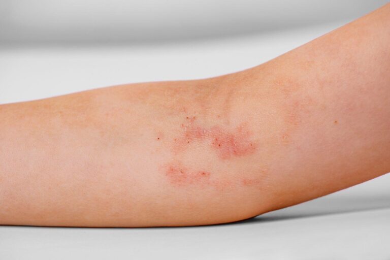 Atopic eczema