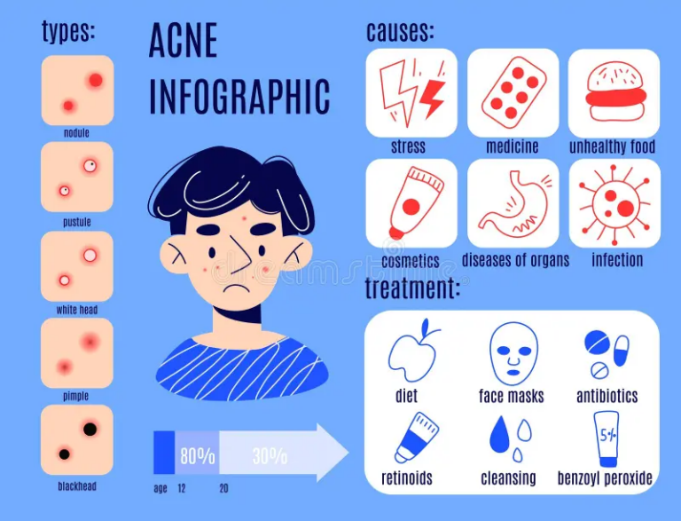 Acne Vulgaris