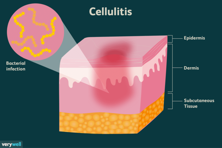 Cellulitis and Erysipelas