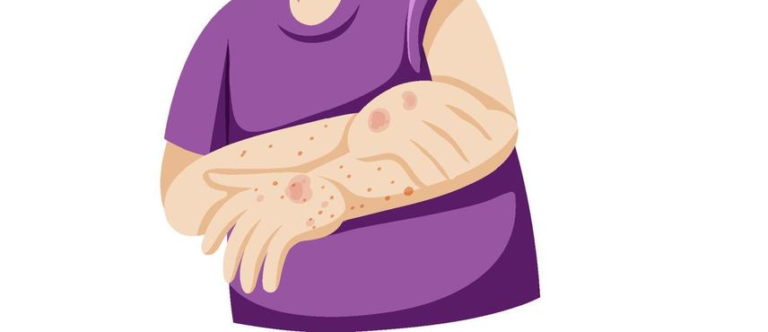 Scabies