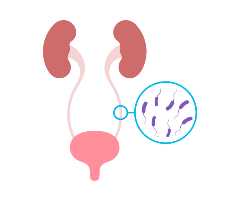 Urinary Tract Infection (UTI)