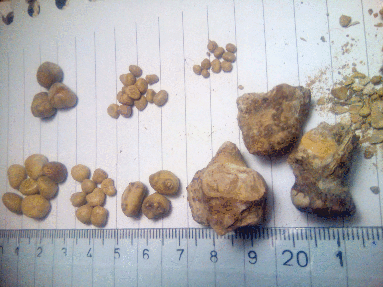 Urolithiasis