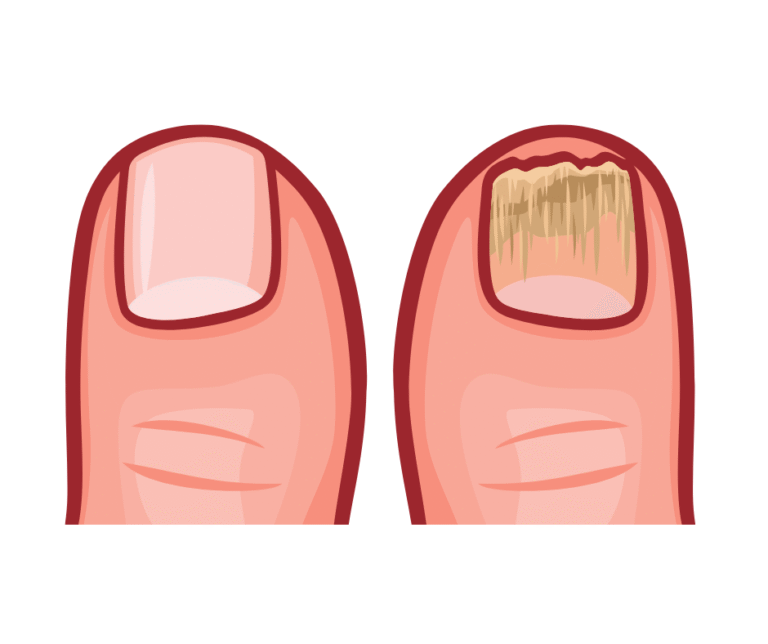 Onychomycosis
