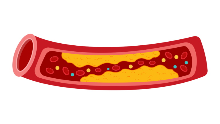 Dyslipidemia