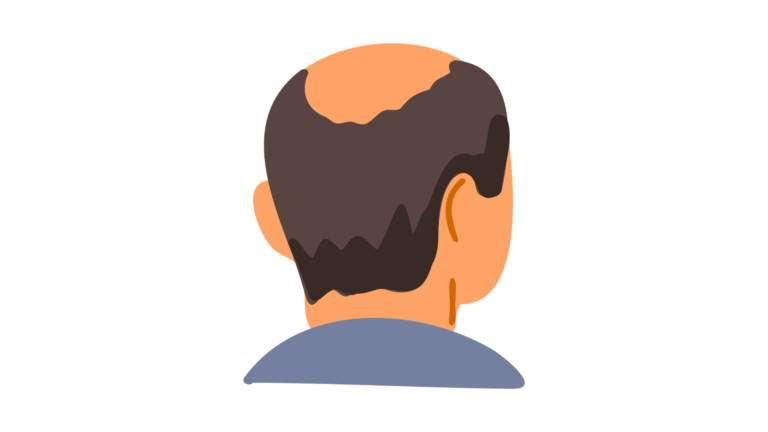 Androgenetic alopecia