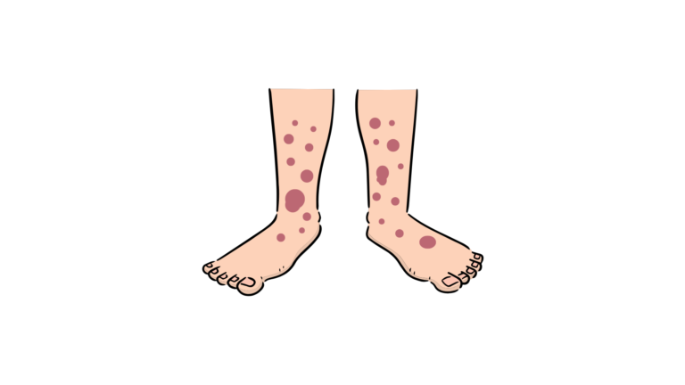 IgA Vasculitis